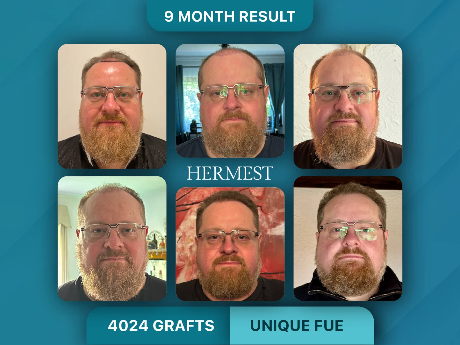 Hair Transplant Before After 4024 Grafts