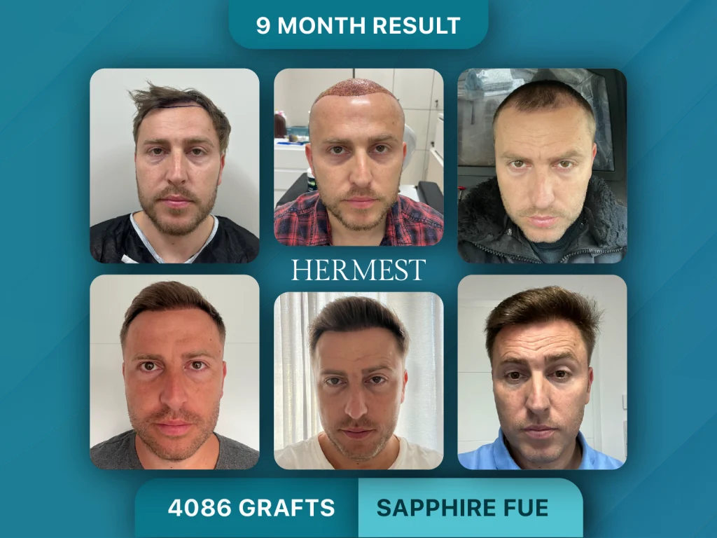 Hair Transplant Before After 4086 Grafts