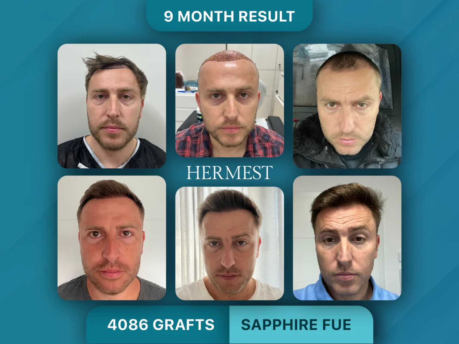 Hair Transplant Before After 4086 Grafts