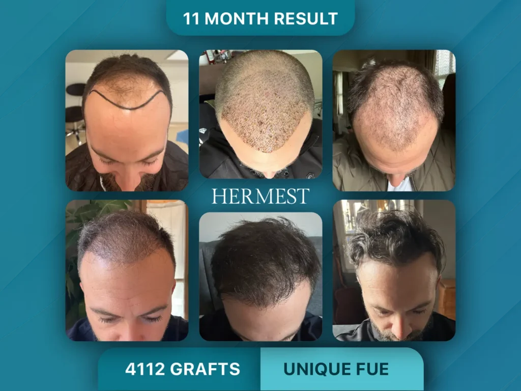 Trapianto di capelli prima e dopo, Unique FUE – 4112 innesti