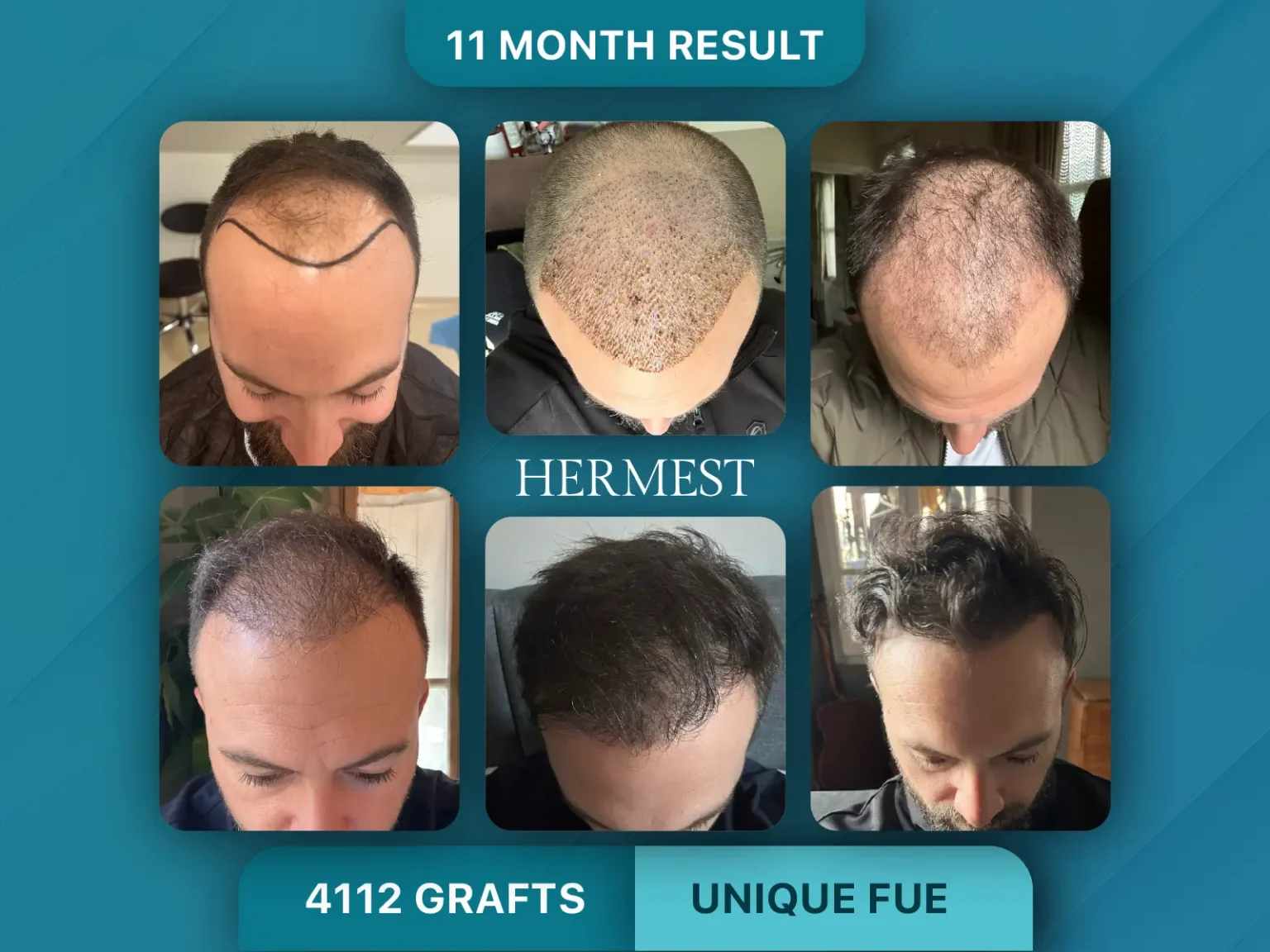 Hair Transplant Before After 4112 Graft