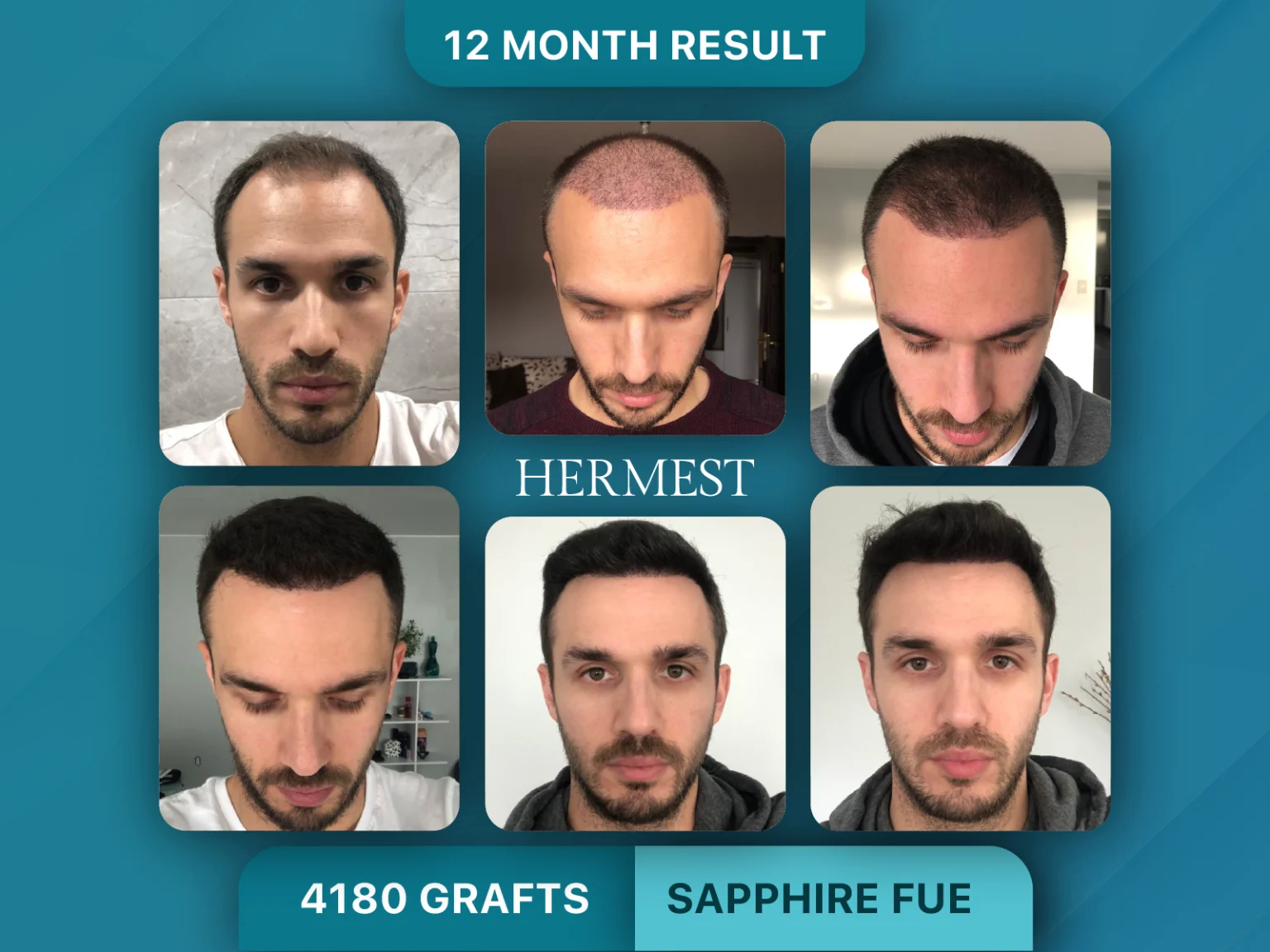 Hair Transplant Before After 4180 Grafts
