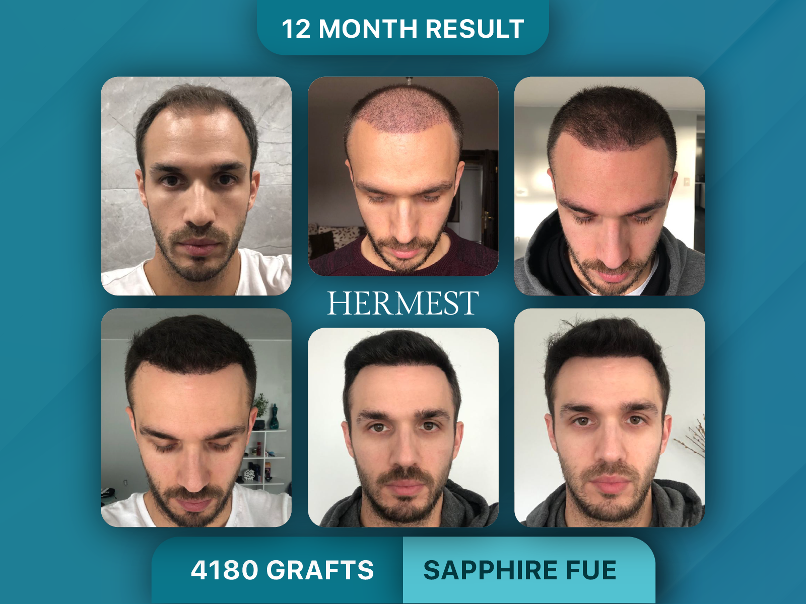 Hair Transplant Before After 4180 Grafts