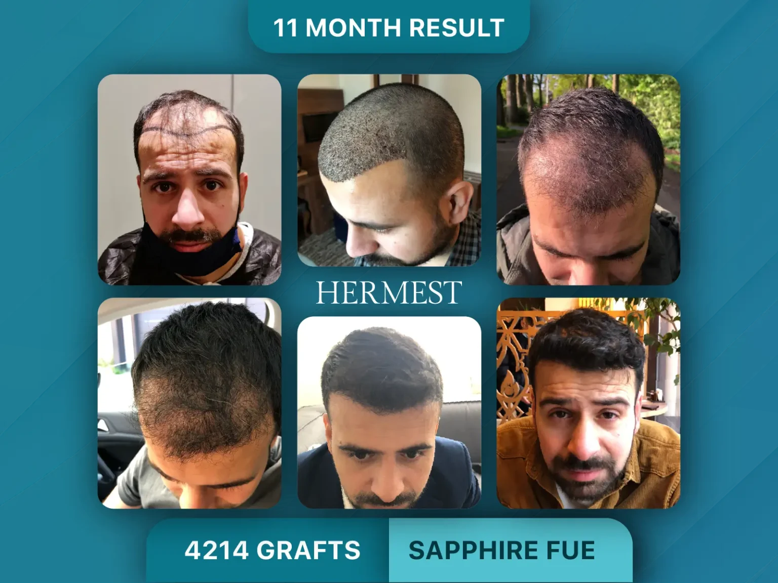 Hair Transplant Before After 4214 Graft