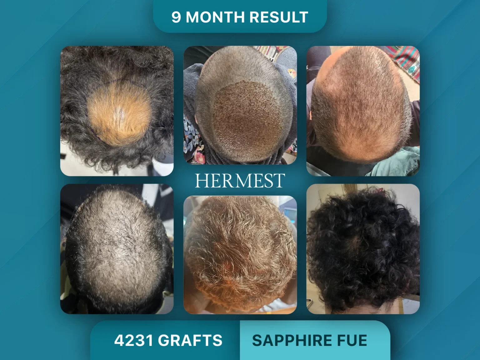 Hair Transplant Before After 4231 Grafts
