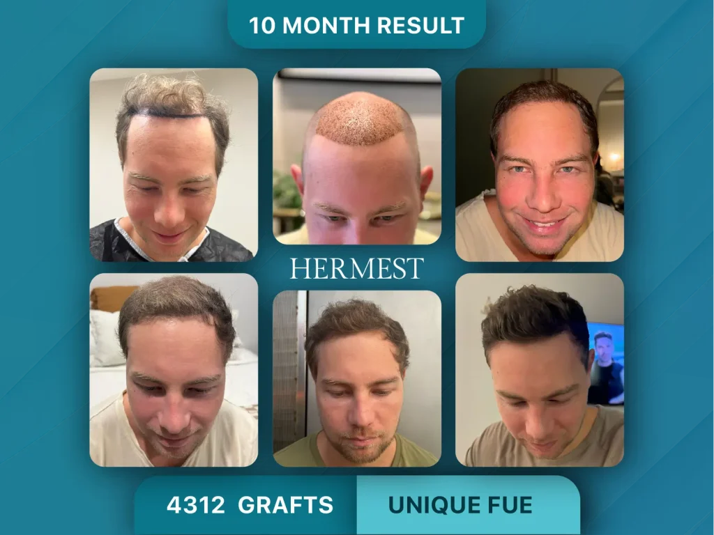 Hair Transplant Before After 4312 Graft