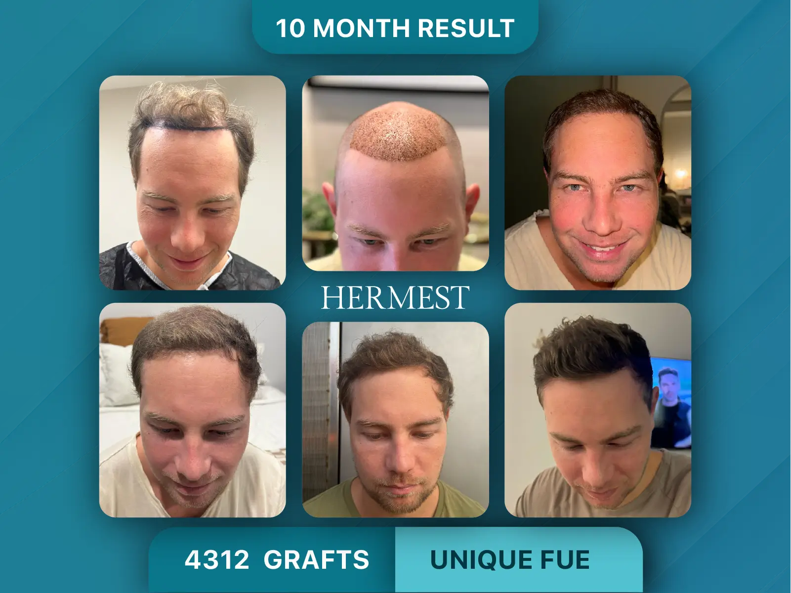 Hair Transplant Before After 4312 Graft