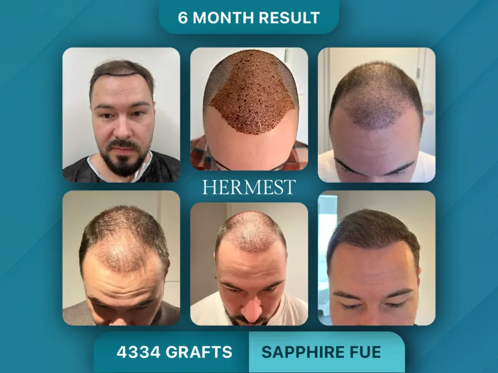 Trapianto di capelli prima e dopo, Sapphire FUE – 4334 innesti