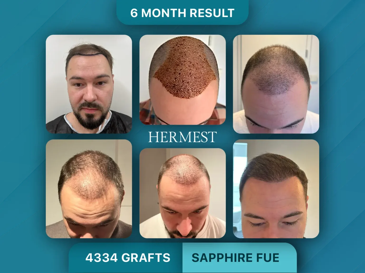 Hair Transplant Before After 4334 Graft