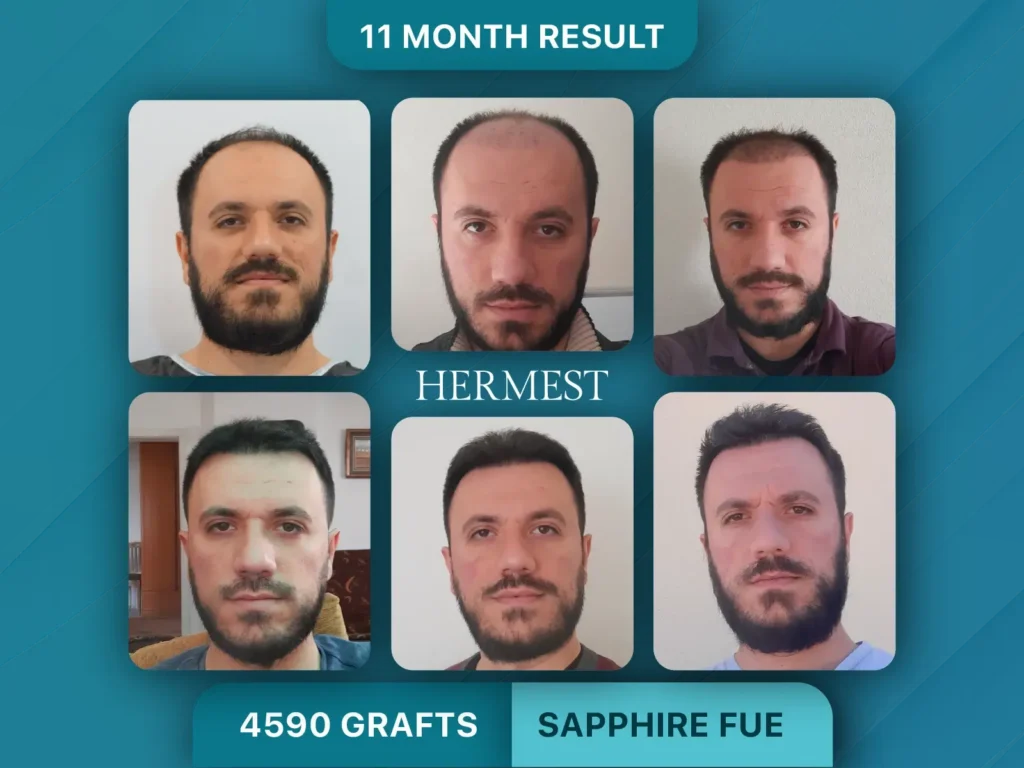 Trapianto di capelli prima e dopo, Sapphire FUE – 4590 innesti