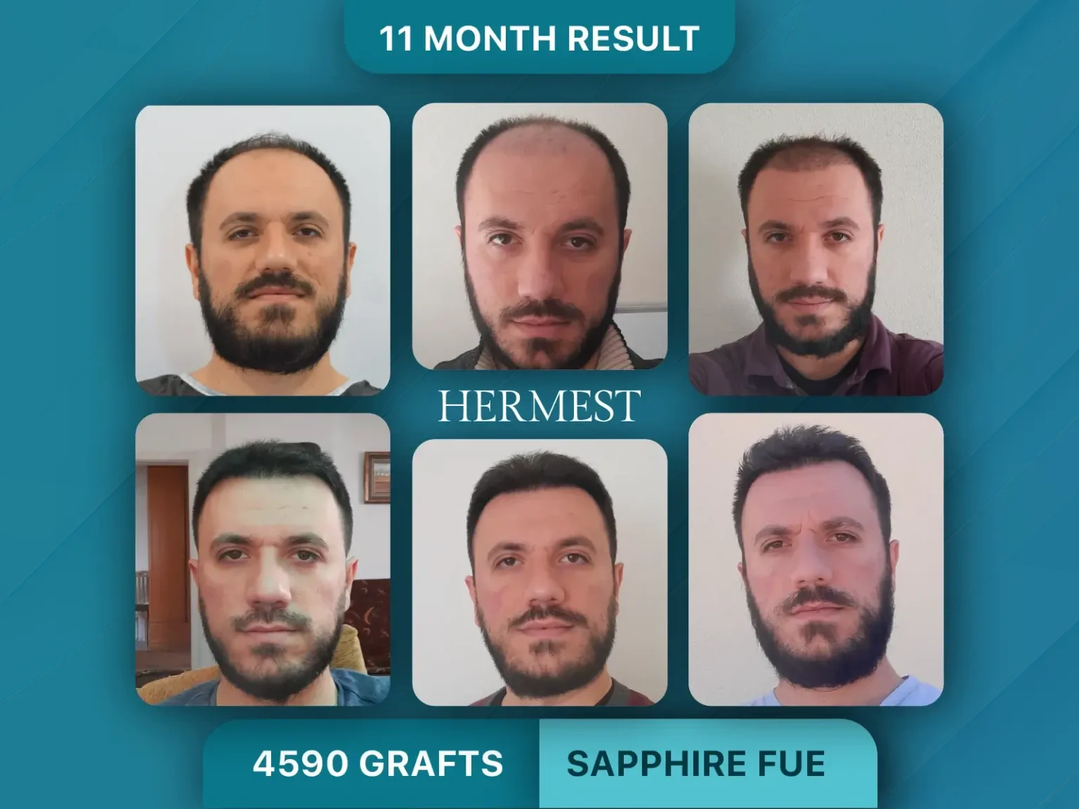 Hair Transplant Before After 4590 Graft