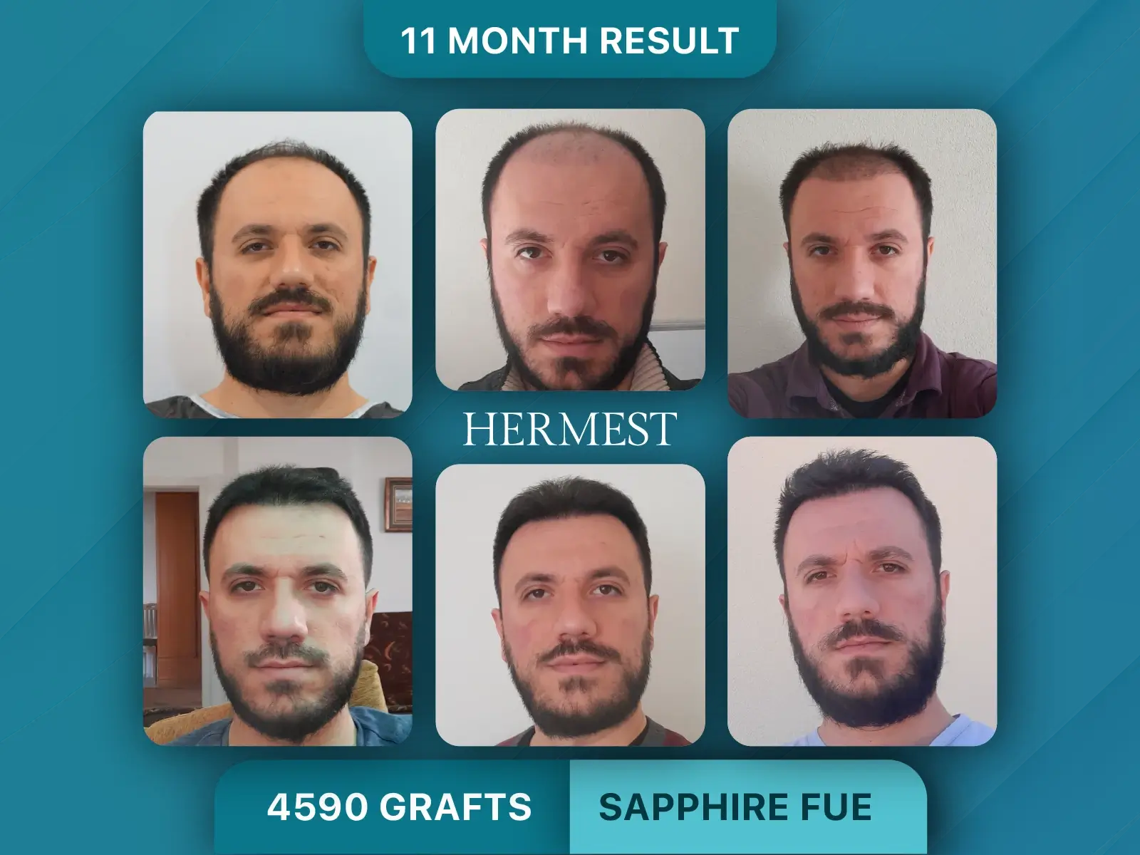 Hair Transplant Side Effects: Risks, Recovery & Prevention 5 Hair Transplant Before After 4590 Graft