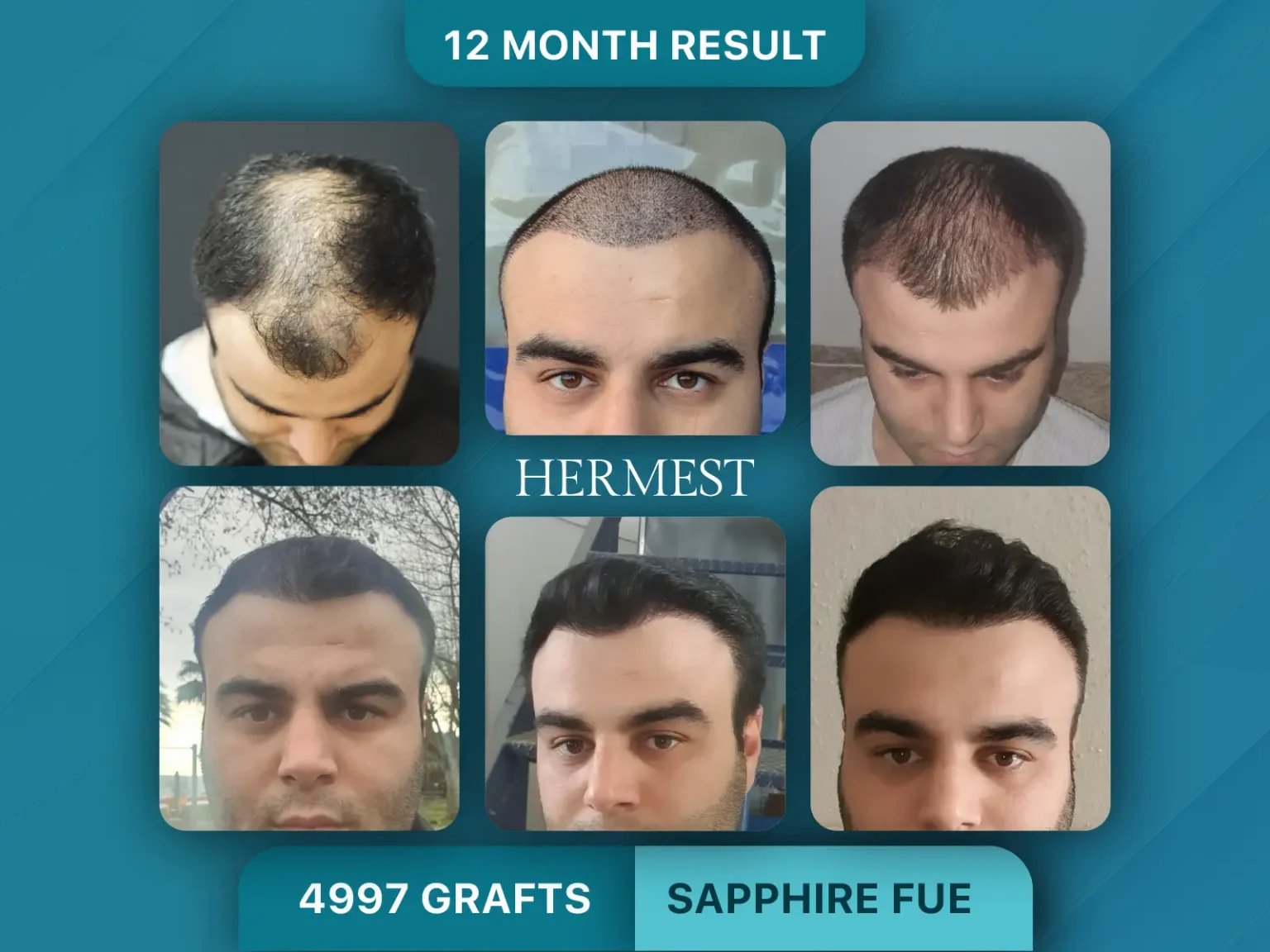 Hair Transplant Before After 4997 Graft