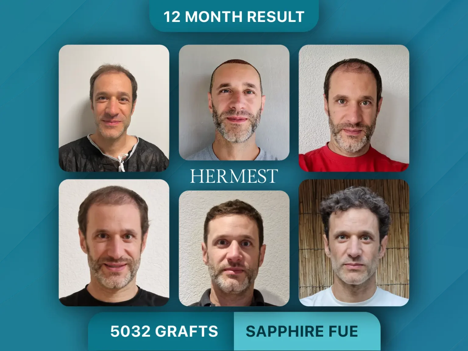 Hair Transplant 6 Months vs 1 Year. Hair Transplant Before After 5032 Graft
