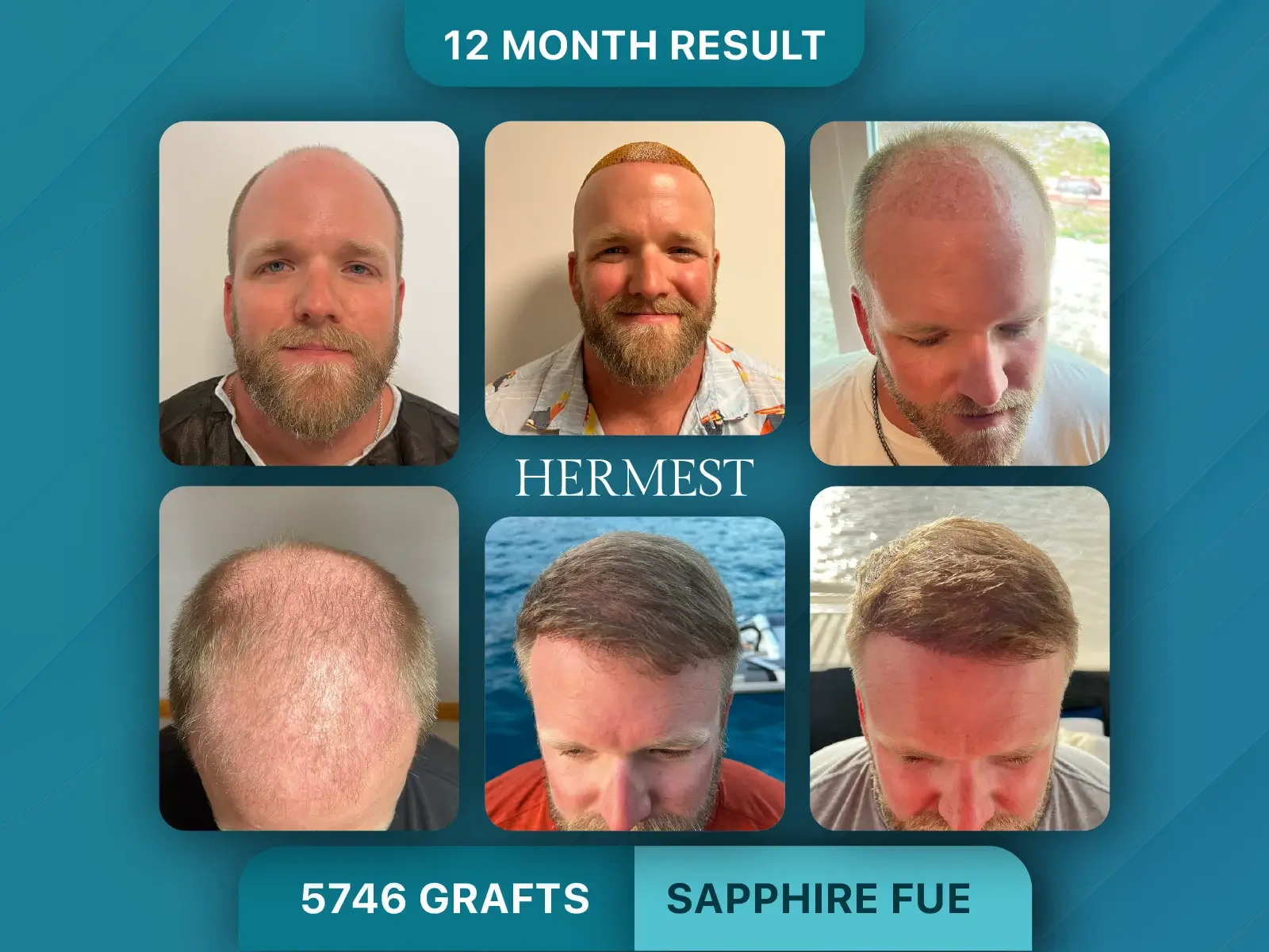 Hair Transplant Turkey Before & After  12 Month Transformation Timeline