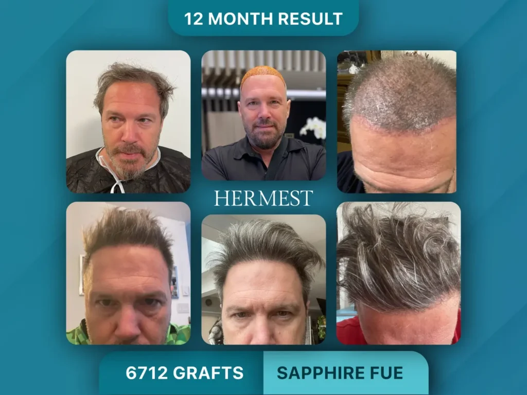 Trapianto di capelli prima e dopo, Sapphire FUE – 6712 innesti