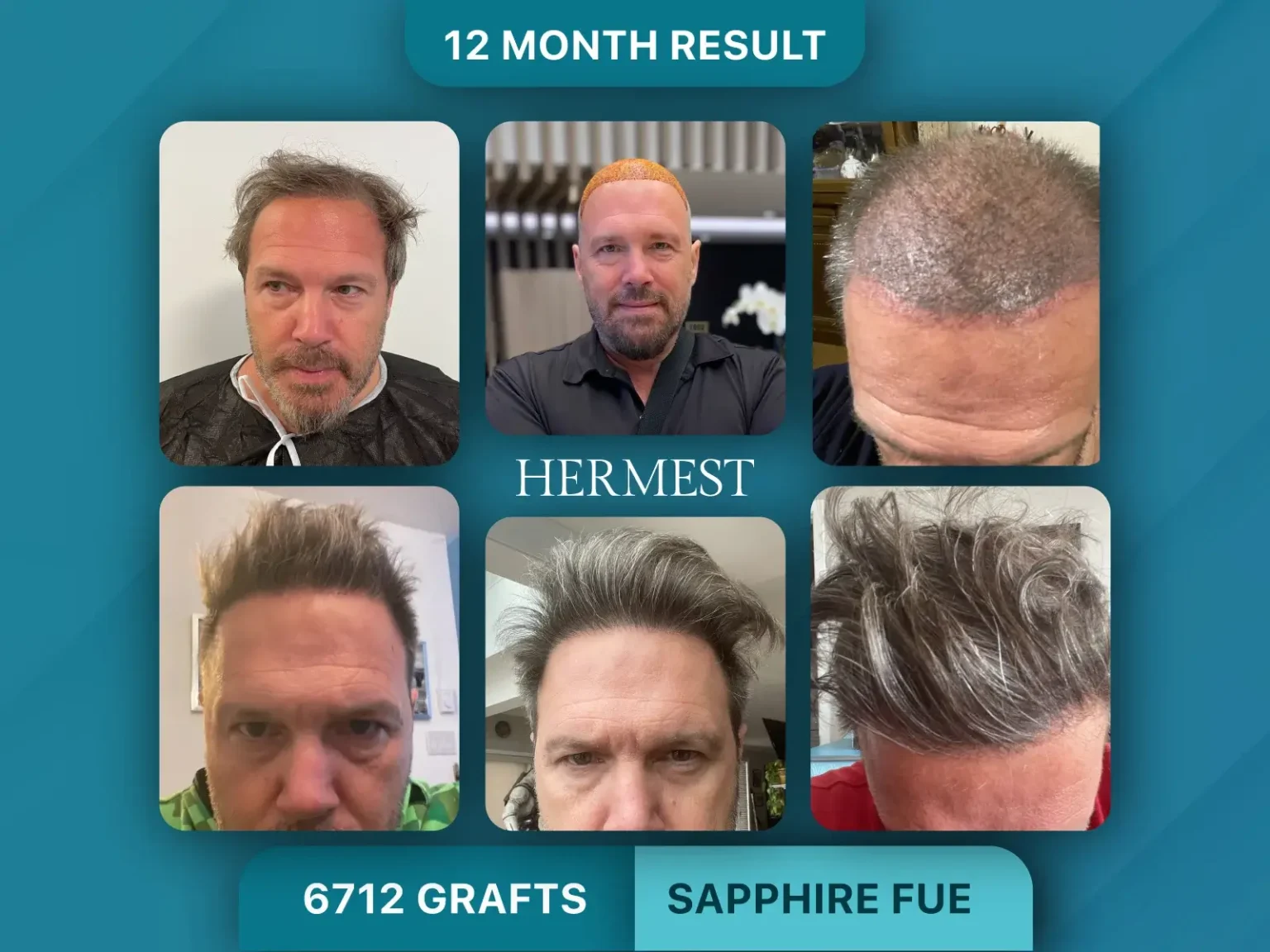 Hair Transplant Before After 6712 Graft