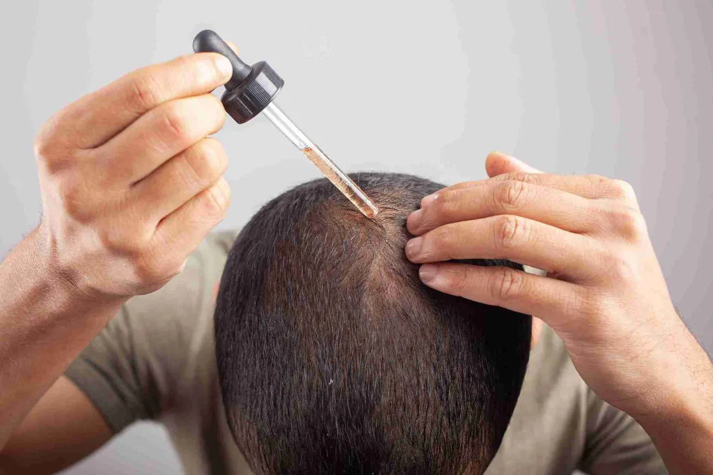 Ein Mann trägt mit einer Pipette Minoxidil gegen Haarausfall direkt auf seine Kopfhaut auf.