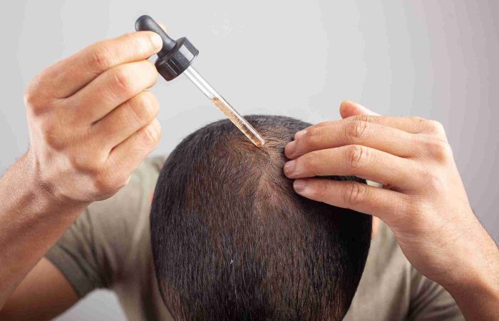 Minoxidil gegen Haarausfall – alles, was Sie wissen müssen 17 Ein Mann trägt mit einer Pipette Minoxidil gegen Haarausfall direkt auf seine Kopfhaut auf.