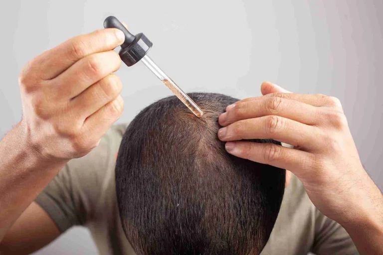 Ein Mann trägt mit einer Pipette Minoxidil gegen Haarausfall direkt auf seine Kopfhaut auf.