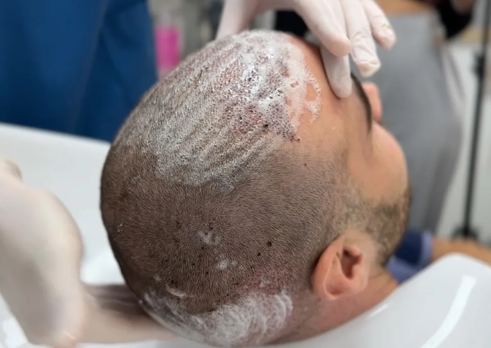 hair transplant scabs