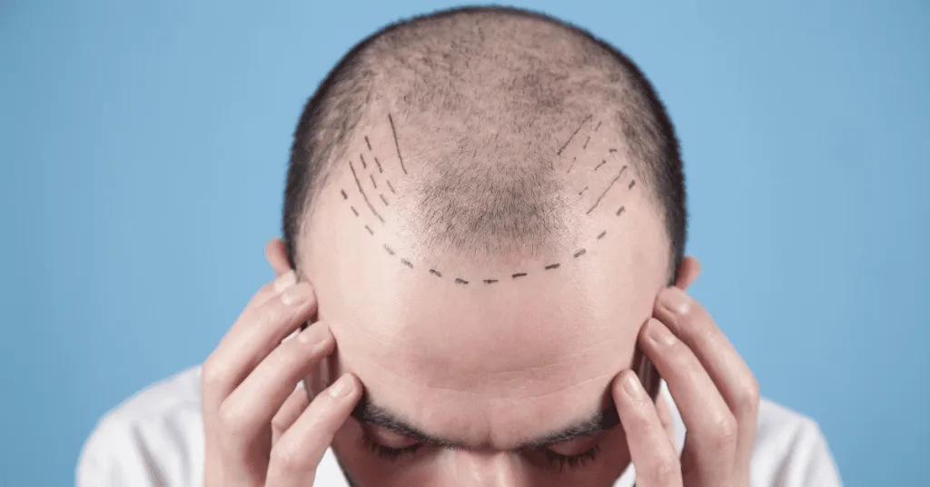 Man with thinning hair and a marked hairline, showing planning for possible hair transplant side effects