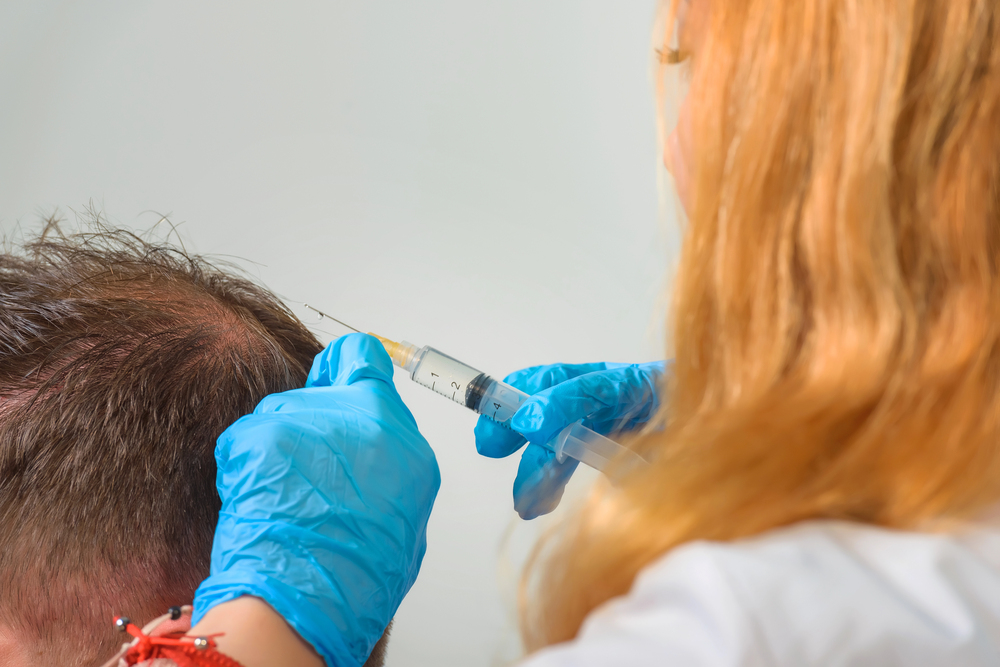 Scalp mesotherapy injection given to a man with thinning hair as supportive hair loss care