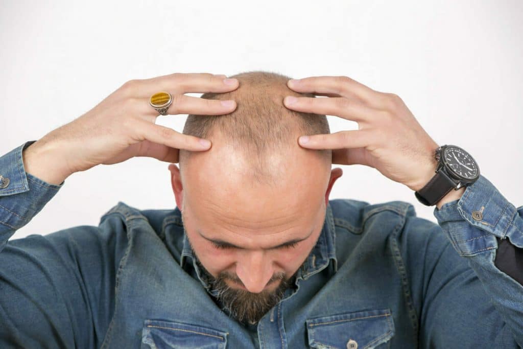 The Advantages and Disadvantages of Hair Transplants: Full Guide 7 numbness after hair transplant