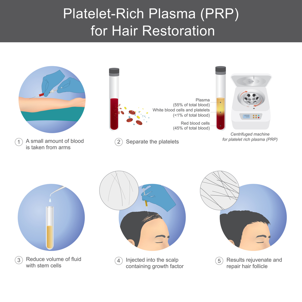 prp for hair loss info