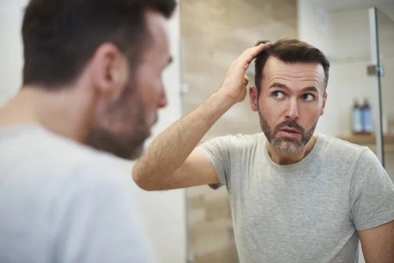 receding hairline best treatment options