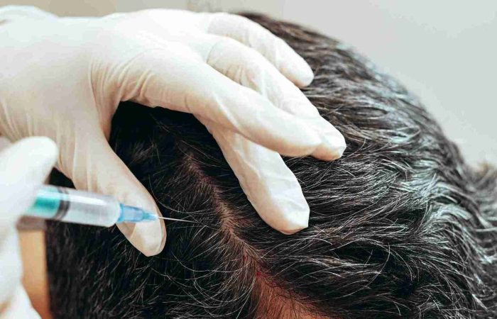 Haartherapie – wirksame Lösungen gegen Haarausfall 14 Medizinische Haartherapie: Eine Person erhält eine Injektion in die Kopfhaut, um das Haarwachstum zu fördern.