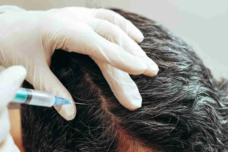 Medizinische Haartherapie: Eine Person erhält eine Injektion in die Kopfhaut, um das Haarwachstum zu fördern.