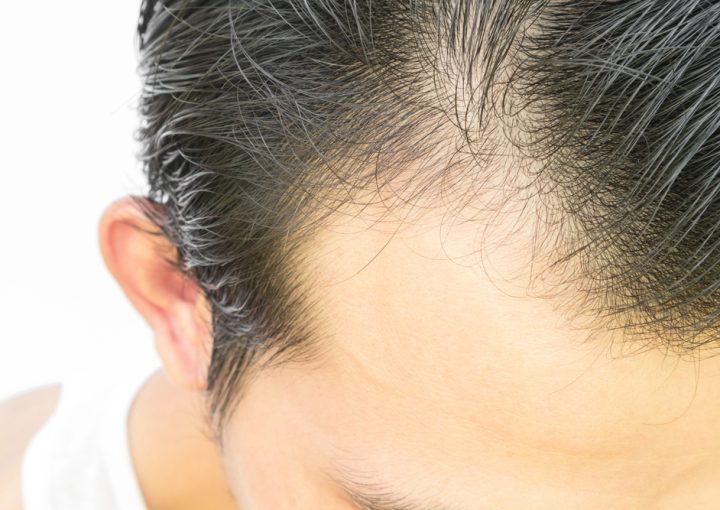 Telogen Effluvium: Causes, Symptoms & Treatment for Hair Shedding 2 telogen effluvium hair loss