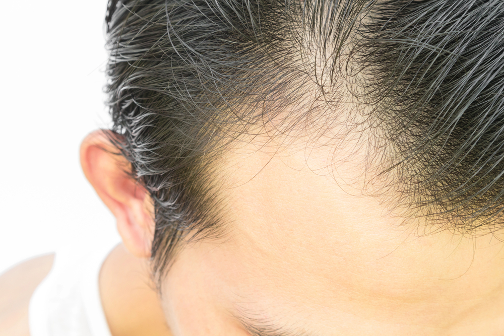 telogen effluvium hair loss