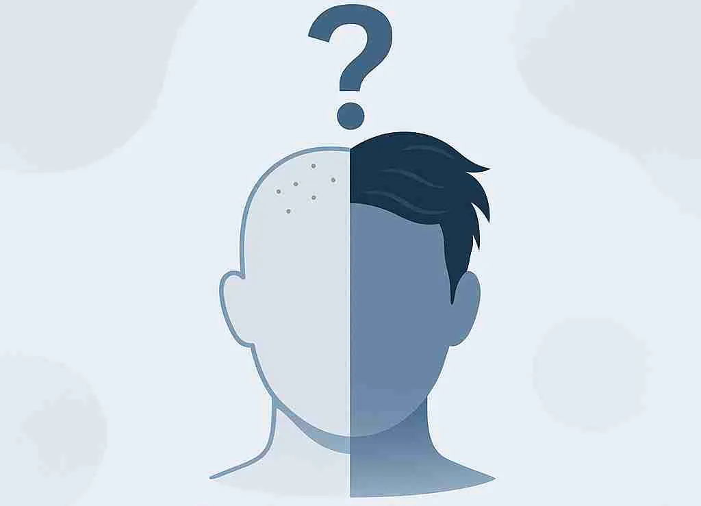 Illustration eines Kopfes, zur Hälfte kahl und zur Hälfte mit vollem Haar, über dem ein Fragezeichen schwebt – visuelle Darstellung der Frage: Können transplantierte Haare wieder ausfallen?