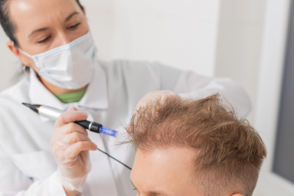 microneedling for hair loss turkey