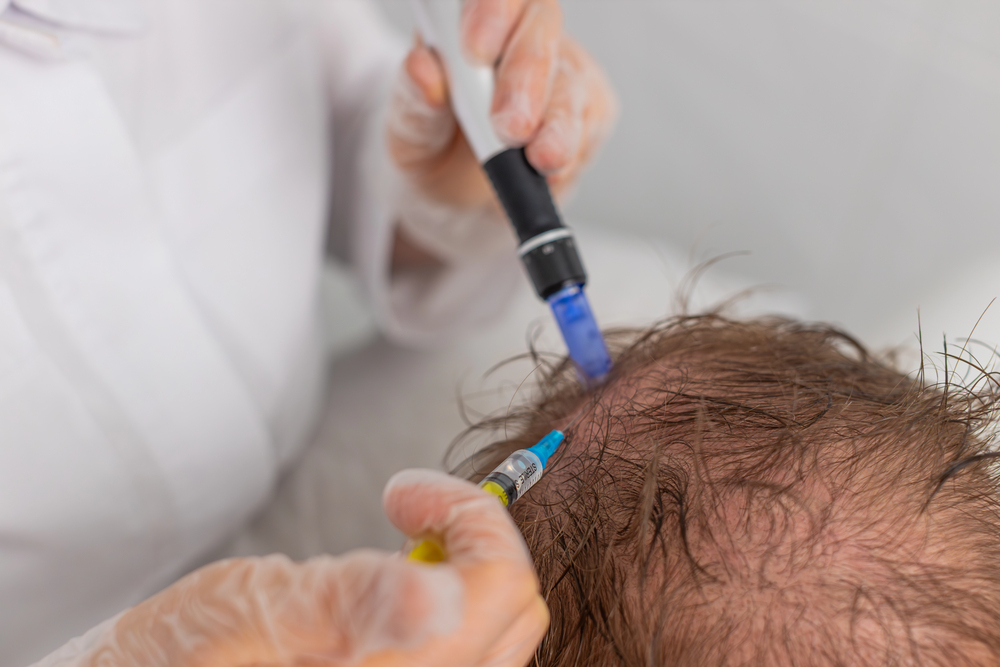 microneedling for hair loss