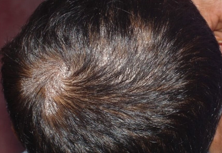 scalp fungus hair loss