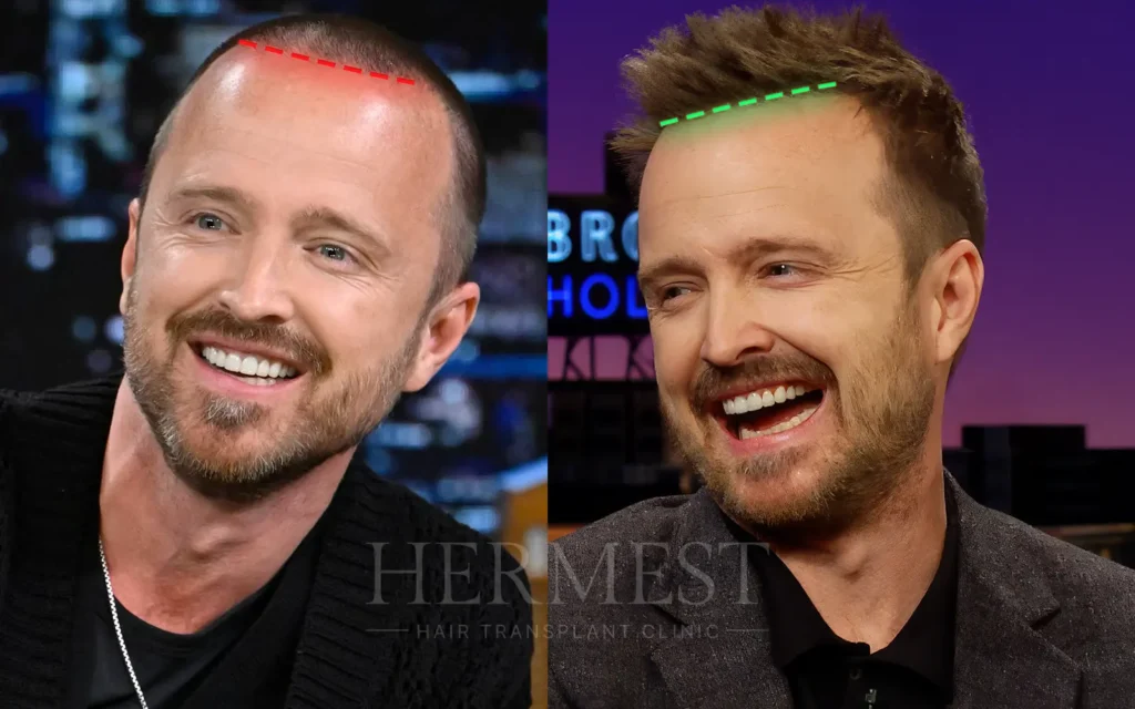 Aaron Paul side by side with marked hairlines, comparing his earlier and later hairline for transplant rumors