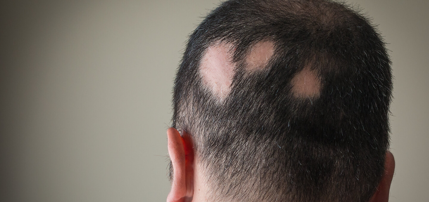 Triangular Alopecia: Causes, Treatment, and Does It Spread? 3 Why it is often mistaken for other hair-loss conditions
