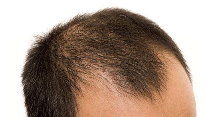 Relationship Between Creatine and Hair Loss: DHT, Shedding & Recovery 7 Genetic hair loss risk