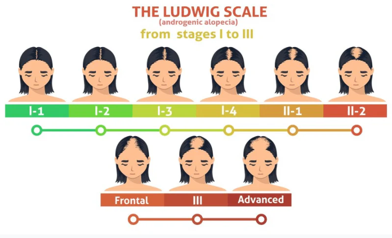 Norwood Scale Explained: Stages of Balding & What to Do 11 Ludwig scale for women