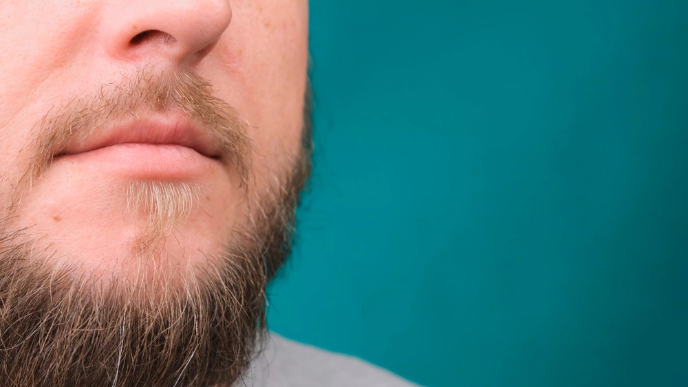 Minoxidil Beard: Growth Results, Timeline, Safety & Side Effects 3 minoxidil for beard growth2