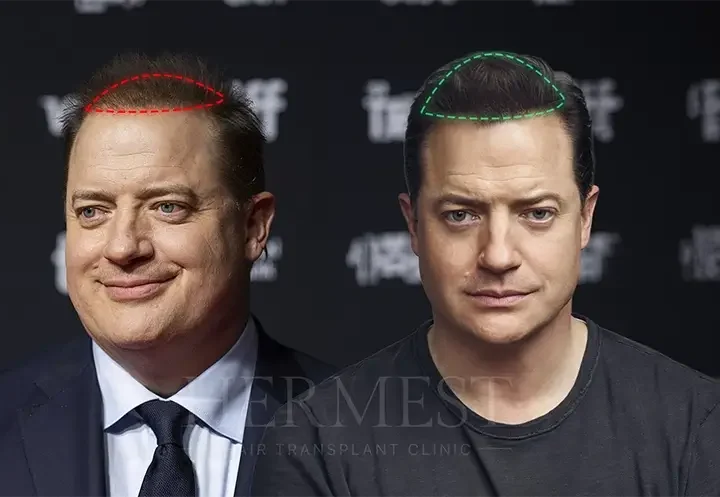 Brendan Fraser Hair Transplant: Facts, Rumours, and Hairline Analysis 17 Brendan Fraser Hair Transplant
