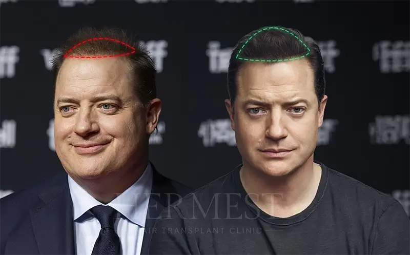 Brendan Fraser Hair Transplant