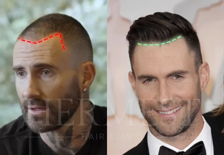 Adam Levine Hair Transplant