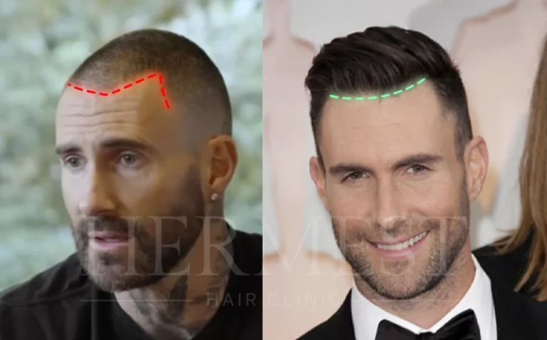 Adam Levine Hair Transplant
