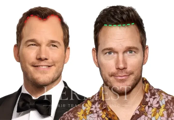 Chris Pratt Hair Transplant: Facts, Hairline Analysis & Truth 8 Chris Pratt Hair Transplant