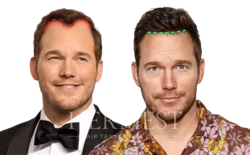 Chris Pratt Hair Transplant