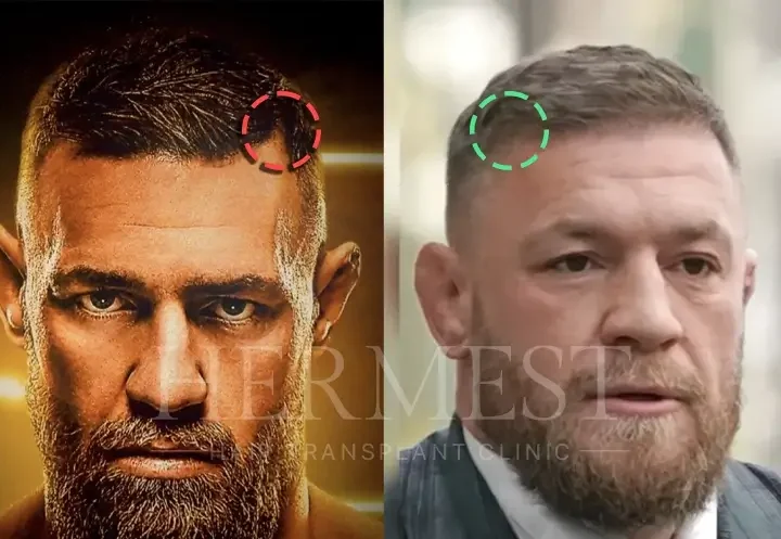 Conor McGregor Hair Transplant: Before & After, Truth & Results 2 Conor McGregor Hair Transplant